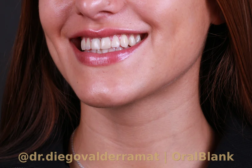 antes blanqueamiento dental Polus Advanced OralBlank Dr Valderrama Santiago