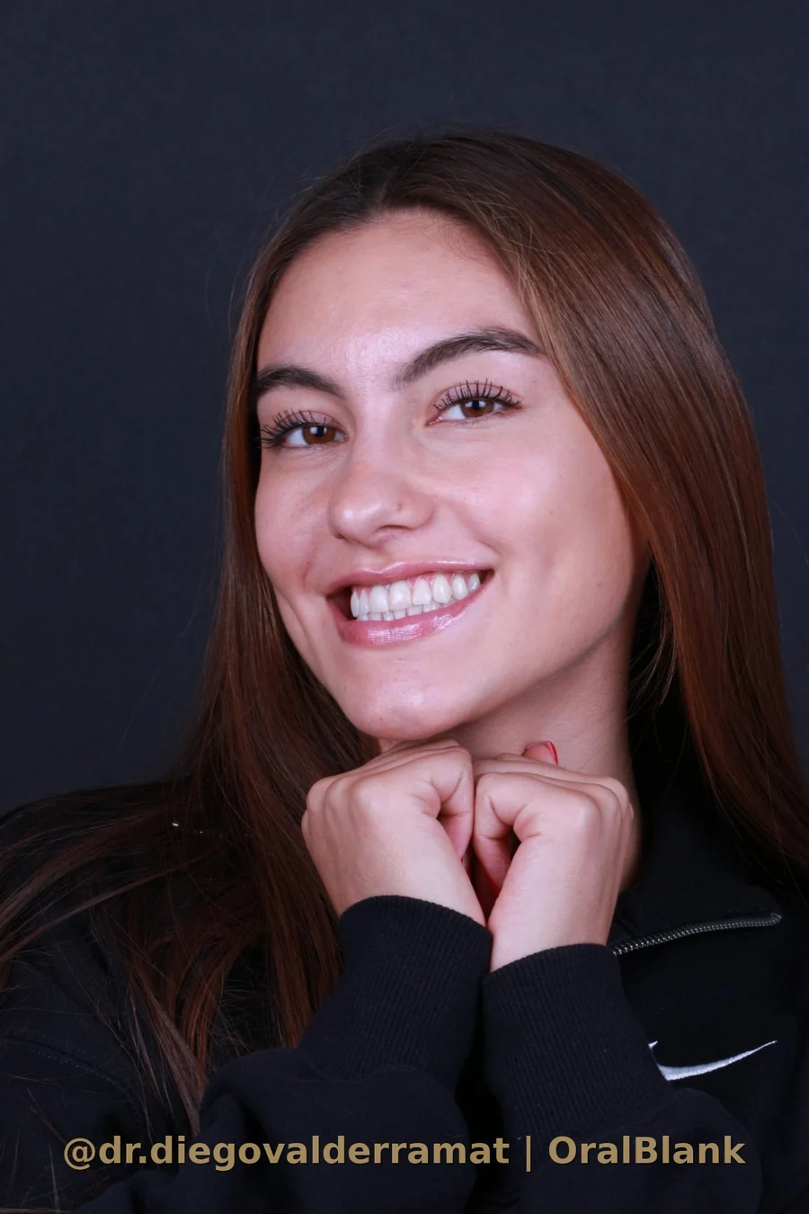 despues blanqueamiento dental resultado Polus Advanced OralBlank Vitacura Santiago