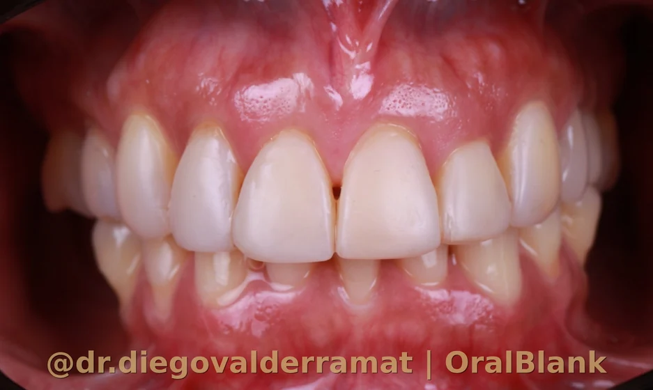antes cambio carillas resina ceramicas OralBlank Dr Valderrama Santiago