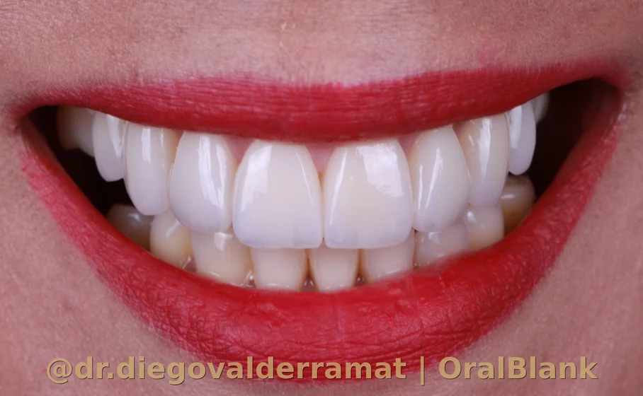 despues carillas ceramicas porcelana resultado OralBlank Vitacura Santiago