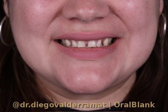 antes carillas porcelana OralBlank Dr Diego Valderrama Santiago Chile
