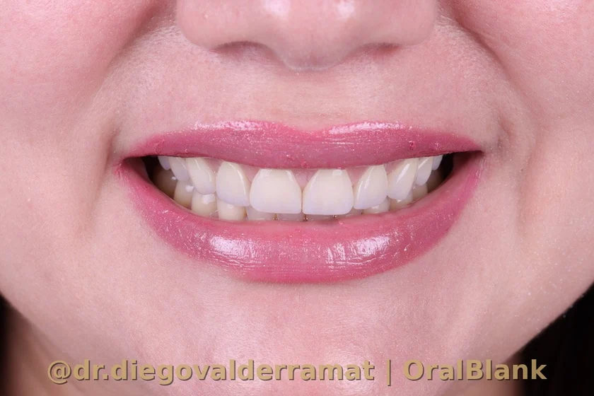 despues carillas porcelana resultado OralBlank Dr Diego Valderrama Santiago