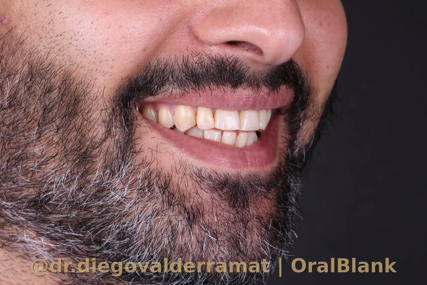 antes carillas porcelana hombre OralBlank Dr Valderrama Santiago Chile