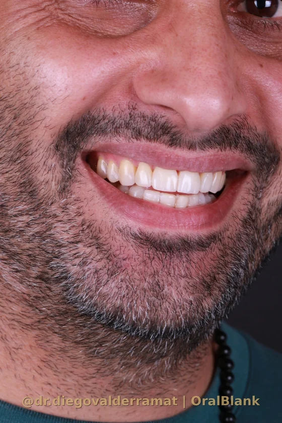 despues carillas porcelana resultado hombre OralBlank Vitacura Santiago