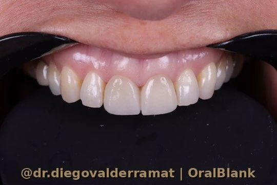 antes diseno sonrisa digital carillas porcelana OralBlank Santiago Chile