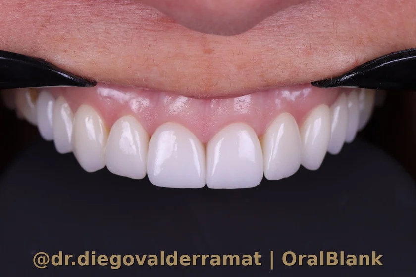despues diseno sonrisa carillas porcelana resultado natural OralBlank Vitacura
